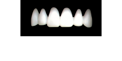 Cod.E2UPPER ANTERIOR : 10x  wax facings-bridges (hollow), LARGE-Wide, (13-23), compatible with solid (not  hollow) wax bridges Cod.S2UPPER ANTERIOR, (13-23)